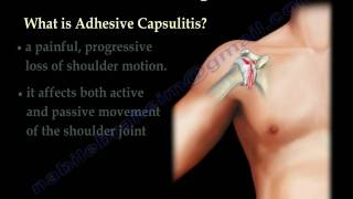 Adhesive Capsulitis frozen shoulder  Everything You Need To Know  Dr Nabil Ebraheim [upl. by Artiek]