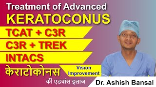 Advanced Keratoconus Treatment C3R Plus TCAT with C3R TREK INTACS  Keratoconus Surgery [upl. by Ametaf]