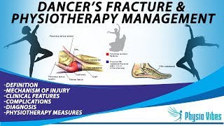 DANCERS FRACTURE amp PHYSIOTHERAPY MANAGEMENT [upl. by Ailliw]