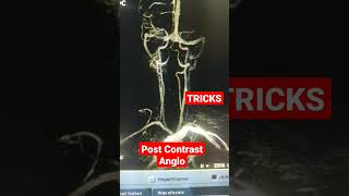 MRI Post Contrast Angio by TRICKS shorts viral [upl. by Aitekram]