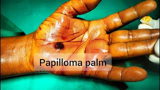 Viral Papilloma of palm Excision under anaesthesia [upl. by Lynch]