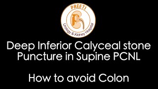 Deep Inferior Calyceal stone puncture in Supine PCNL  How to avoid colon [upl. by Einafets]