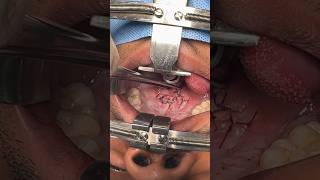 Double opposing z plasty and intra velar veloplasty to improve VPI and speech surgery [upl. by Robby797]