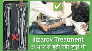 ILIZAROV TREATMENT IN Nonunion fracture ilizarovsurgery fracture नही जुड़े फ्रेक्चर का इलाज [upl. by Cadman]