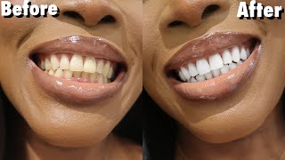 😮 Top 2 Natural Ingredients To Whiten Teeth At Home WITHOUT Hydrogen Peroxide Alkaline [upl. by Eilah]