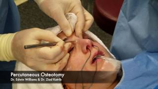 Percutaneous Osteotomy amp Breaking the Nose During Rhinoplasty Surgery [upl. by Rehsu]