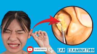 Many Ear Waxes Cause Hearing Problems Part 17 [upl. by Ayeka43]