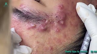 Big Cystic Acne Blackheads Extraction Blackheads amp Milia Whiteheads Removal Pimple Popping [upl. by Tareyn243]