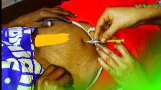 How to inject Filgrastim PFS 30 MIU05 ml Filastin 30  Subcutaneously Navel Injection Push Video [upl. by Martie426]