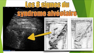 8 aspects de pneumopathie en échographie [upl. by Danieu]