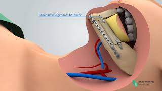Herstel onderkaak [upl. by Ciccia]