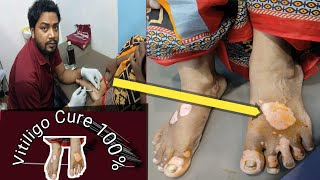 new treatment vitiligo hindi  new vitiligo injection new medicine 2024  wbmalda india [upl. by Oidacra457]