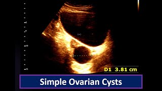 Understanding Simple Ovarian Cysts Ultrasound Findings  Ovarian Cyst  Simple follicular cyst [upl. by Izy]