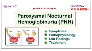 Paroxysmal Nocturnal Hemoglobinuria  PNH  SymptomsPathogenesisLab FindingsTreatment pathology [upl. by Klockau]