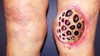 Top 100 Trypophobia Disease Photos Ever NSFE [upl. by Natika]