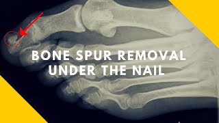 Bone Spur Under Big Toe Nail Subungual Exostosis [upl. by Ythomit]