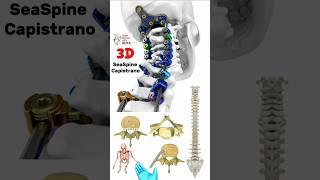 SeaSpine Capistrano medical animation 3d short  BiologywithAliya [upl. by Trstram850]