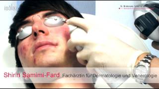 AKNE LIVEBEHANDLUNG  Isolaz und Fraxel Laser  DERMA LOFT Gladbeck [upl. by Merri757]