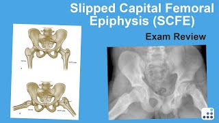 Slipped Capital Femoral Epiphysis SCFE Exam Review  William Jiranek MD [upl. by Nidya]