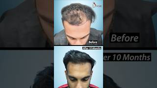 Restore Your Hair Without Shaving Long Hair Transplant Before and After shortsfeed [upl. by Nevi]