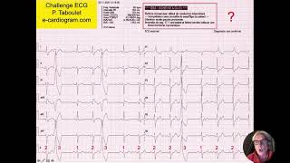 Rythme sinusal avec extrasystoles  Algorithme utile  Quiz ECG Dr Taboulet [upl. by Hniht221]