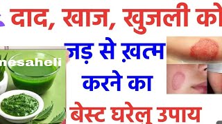 दाद खाज खुजली की 4 दिन में छुट्टी कर देगा Fungal Infection Treatment athome Daad Khaj Khujli ka ilaj [upl. by Ahsiat]