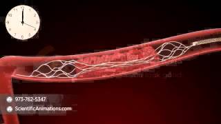 Mechanical Thrombectomy  Neurovascular stent deployment [upl. by Merc]