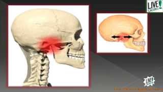 ¿Qué es el síndrome de disfunción temporomandibular ATM [upl. by Zurkow]