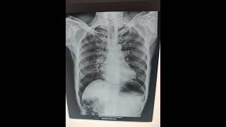 Peritonitis  pneumoperitoneum  chest x ray srivarihospital [upl. by Allak]