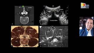 Ultrasound Imaging of the Lumbar Spine Relevant for Neuraxial Blocks Dr Manoj Karmakar Hong Kong [upl. by Nats285]