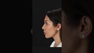 Removing Previous Nose Filler  Rhinoplasty [upl. by Hilton354]