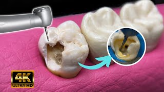 Reparacion dientes con caries  Endodoncia en 4K  Muela rota [upl. by Bea642]