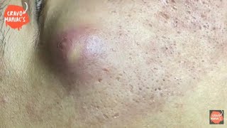 Tirando Cravos e Espinhas  Blackheads 150 [upl. by Reisch]