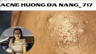 Acne Treatment Huong Da Nang 717  Remove Blackheads [upl. by Olathe]