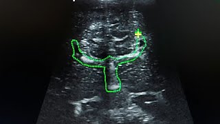 cranial ultrasound  agenesis of the corpus callosum [upl. by Mharba]