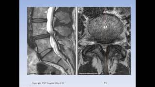 Lumbar Spinal Stenosis Cauda Equina Syndrome Sciatica amp Disc Herniation An Advanced Lecture [upl. by Naivaj]