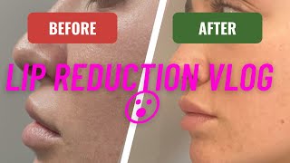 Lip Reduction Surgical Procedure vlog including Side Effects and footage of full process [upl. by Etteval701]