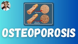 Osteoporosis  Bimithas Nursing Guide osteoporosis psckerala [upl. by O'Dell]