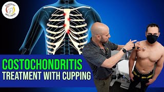 Costochondritis Treatment with Cupping [upl. by Kiernan]