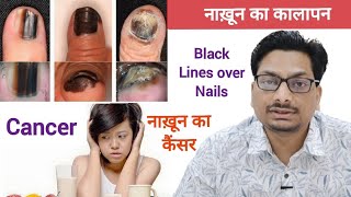 Nail Melanoma  नाख़ून का कैंसर  नाख़ून का कालापन  Black Lines on Nail nailcancer melanonychia [upl. by Kina]