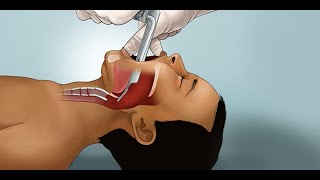 Pediatric Endotracheal Intubation by J Nagler et al  OPENPediatrics [upl. by Korry920]