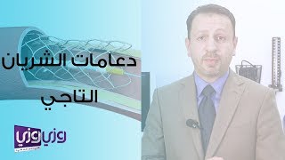 دعامات الشريان التاجي [upl. by Nnylsoj]