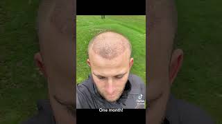 HAIR TRANSPLANT BEFORE AFTER  11 MONTHS [upl. by Mord706]