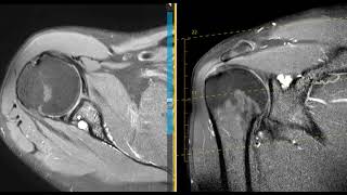 Shoulder pain from labral tear with paralabral cyst [upl. by Uv]