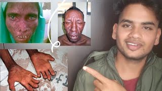 क्यू होता है LEPROSY  Leprosy Treatment  HINDI  leprosy BENATURALBEFIT [upl. by Acirehs]