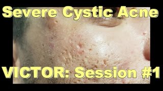 Severe Cystic Acne  Victor Session 1 [upl. by Grati]