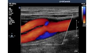 NORMAL CAROTID ARTERY [upl. by Anikehs436]