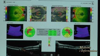 Retinopatia e Maculopatia Diabetica come prevenirle e quali trattamenti innovativi [upl. by Celestia136]