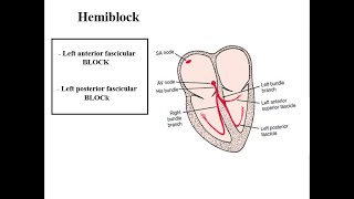 Hemiblock  LPFB  LAFB [upl. by Nnyllatsyrc17]