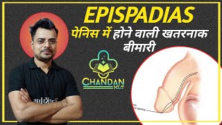 Epispadias in hindi  Epispadias  causes  symptoms  Diagnosis treatment  Chandan Mlt  RanKplus [upl. by Nerrat]